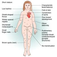 Turner Syndrome